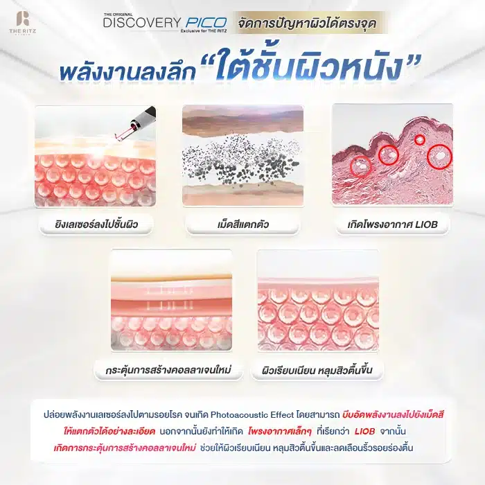 งานกลุ่มแก้ PICO AW SEO Infograhic ใต้ผิวเกิดอะไร