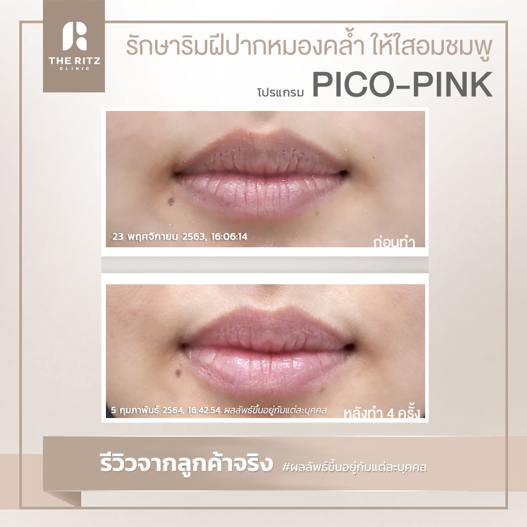 รีวิวpico20