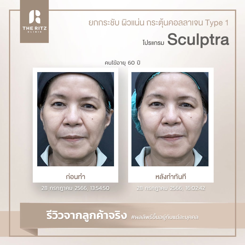 sculptra014