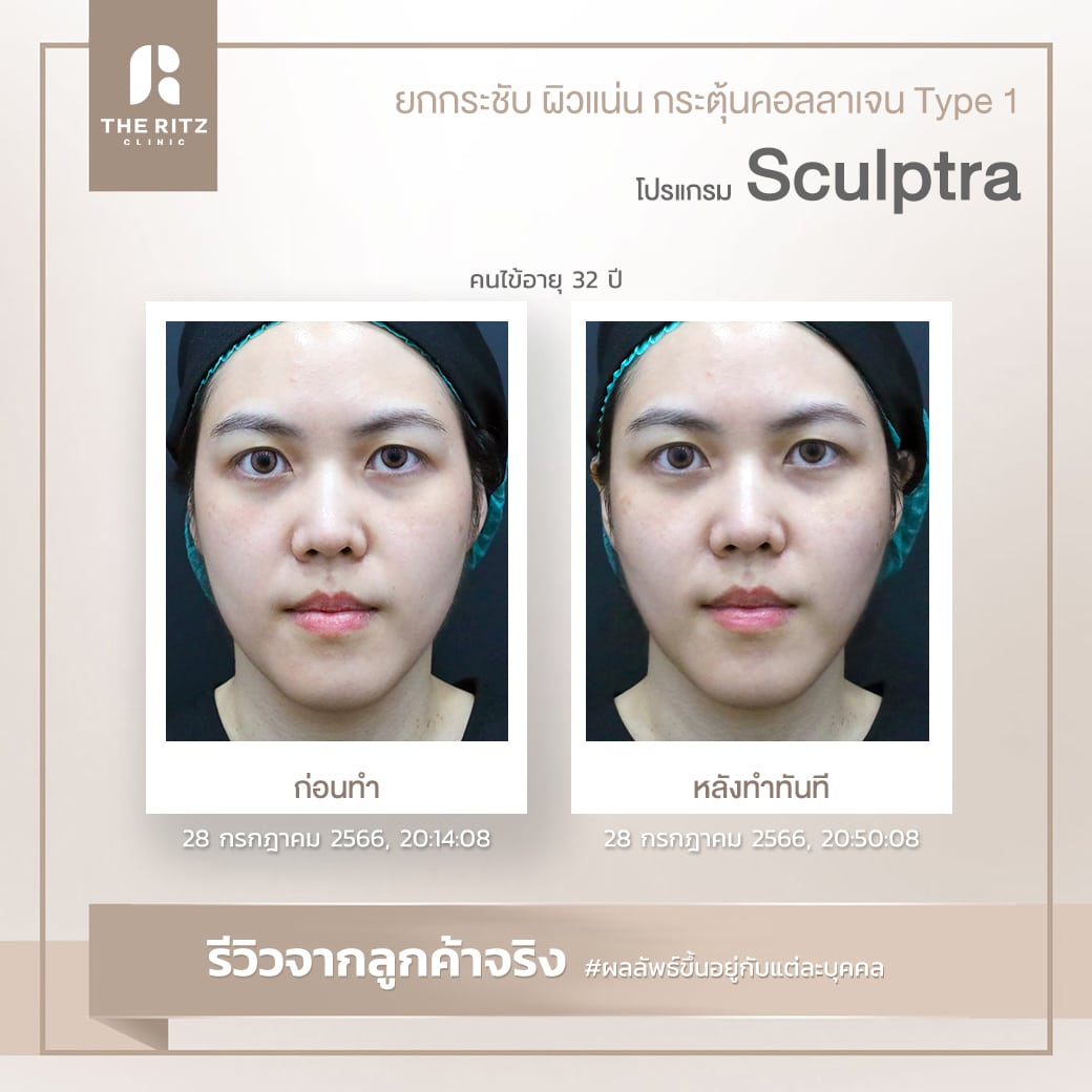 sculptra015