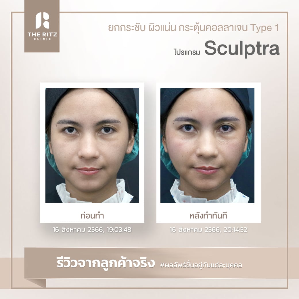 sculptra09