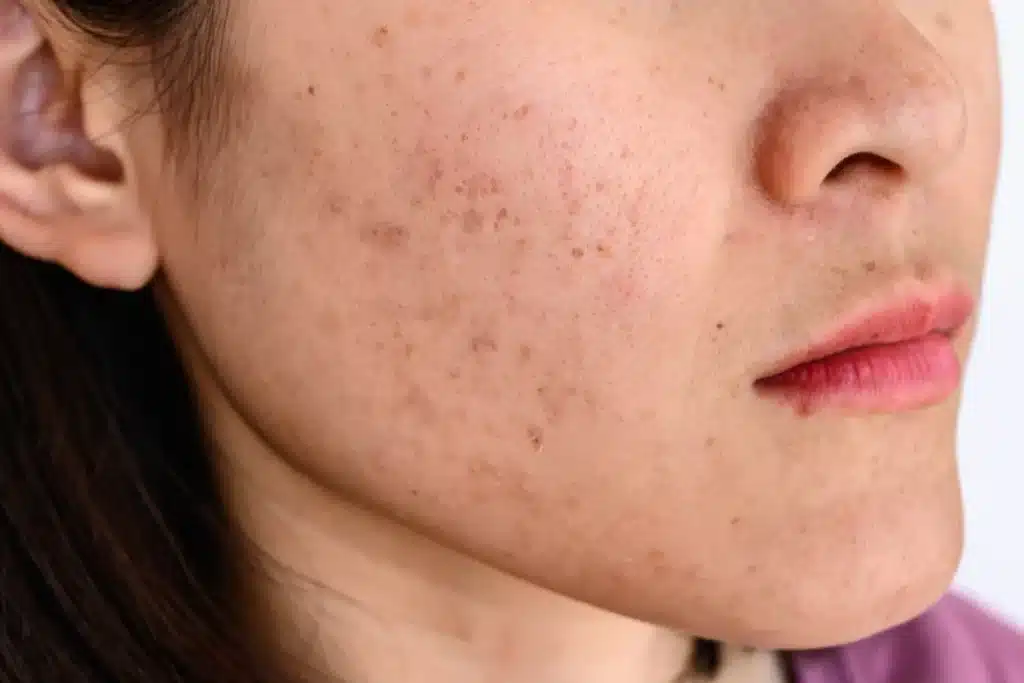 รอยหลุมสิวเกิดจากอะไร รักษายังไงเนียนเรียบ