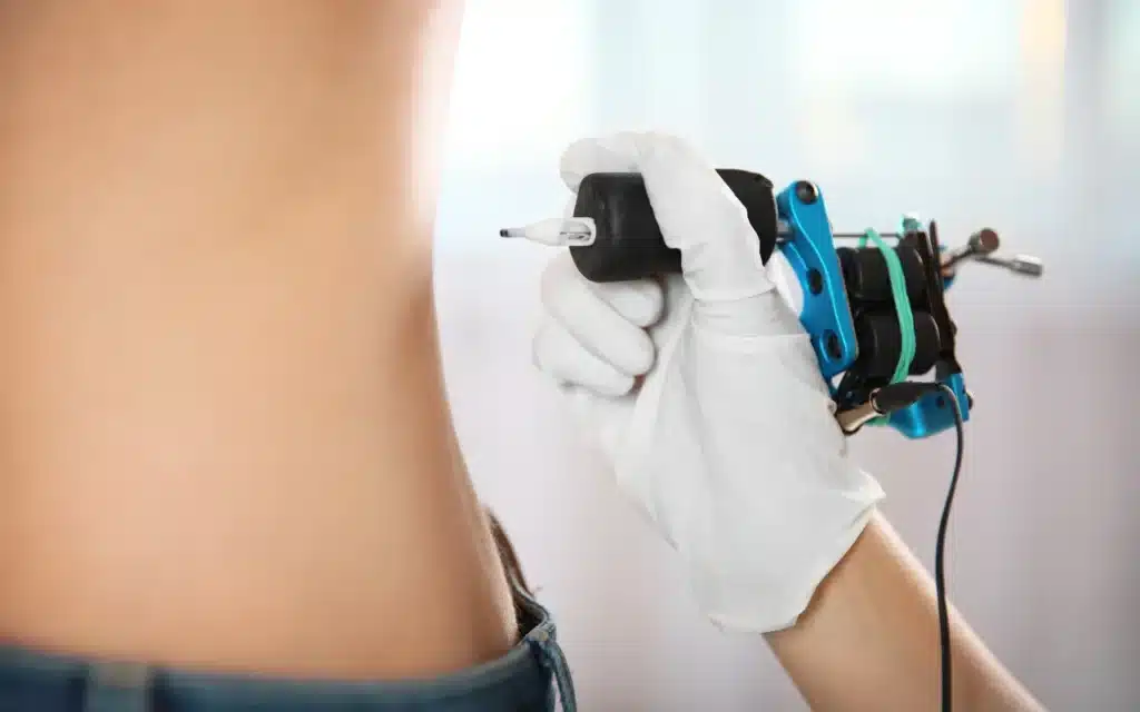 เลเซอร์ลบรอยสัก คืออะไร