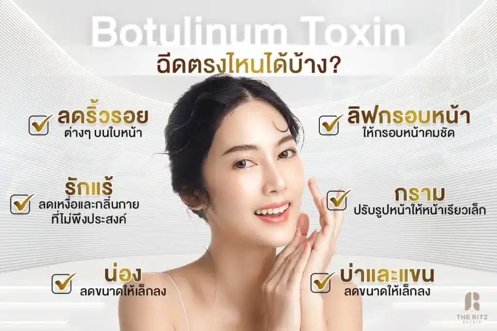 Botulinum-Toxin-ฉีดตรงไหน