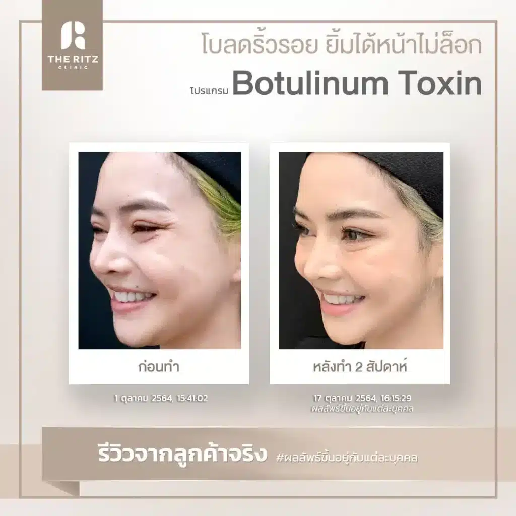 botulinum toxin