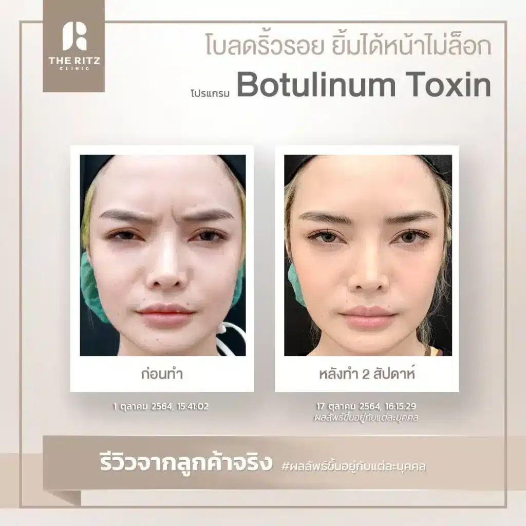 botulinum toxin