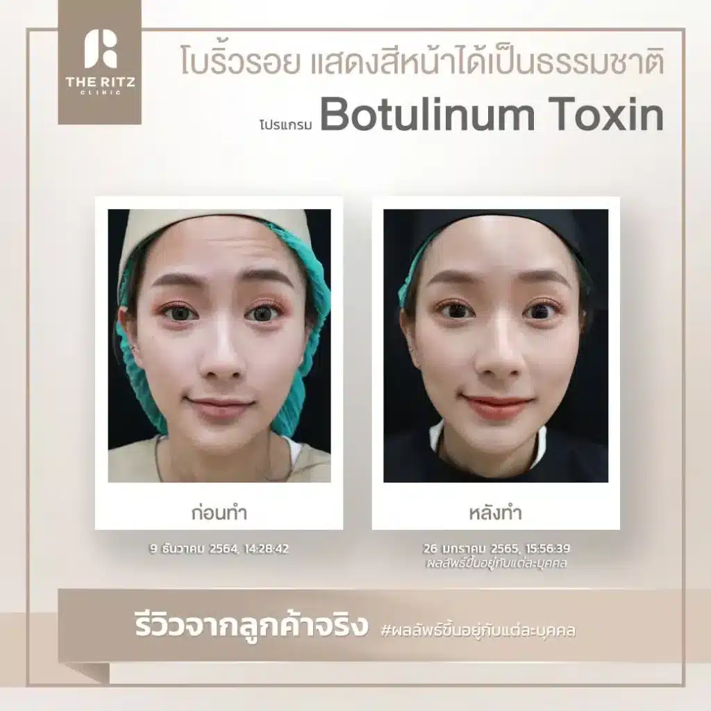 botulinum toxin
