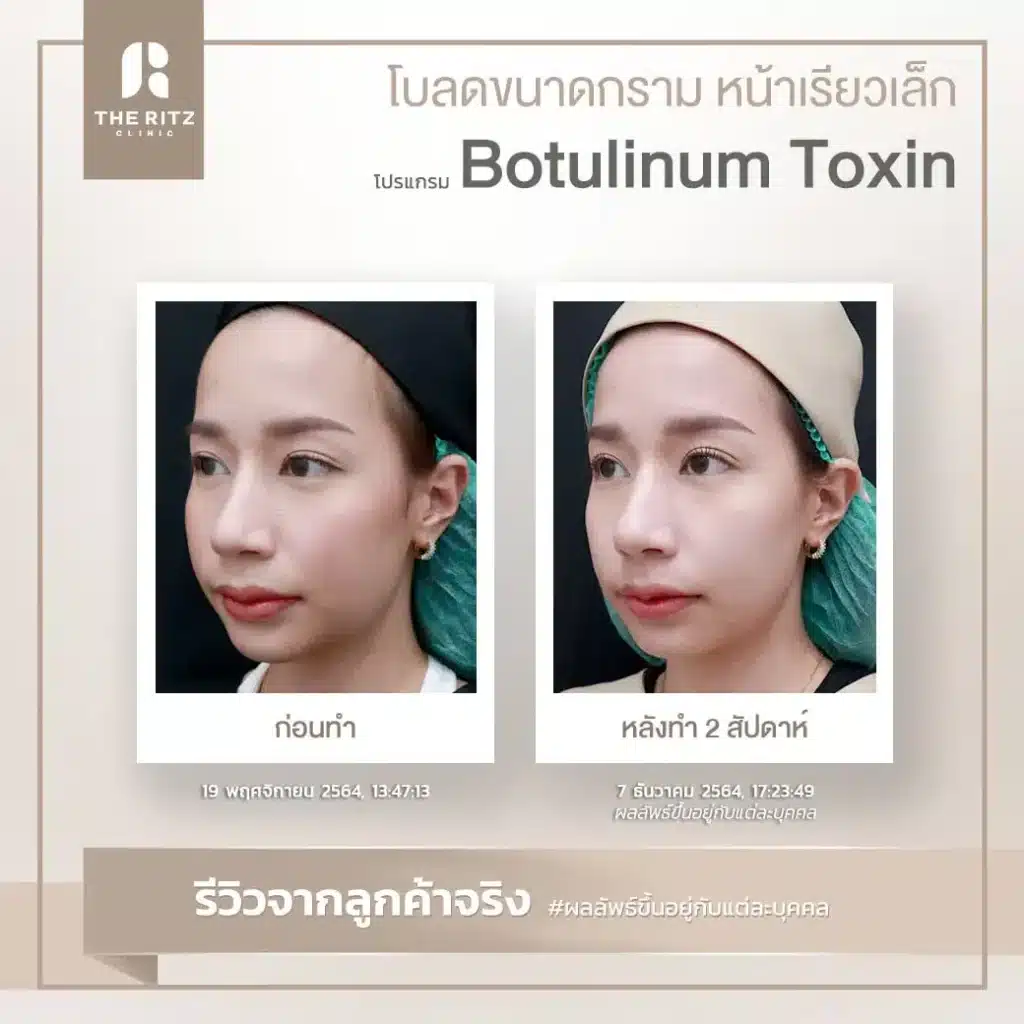 botulinum toxin