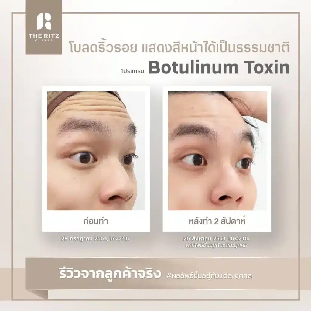 botulinum toxin