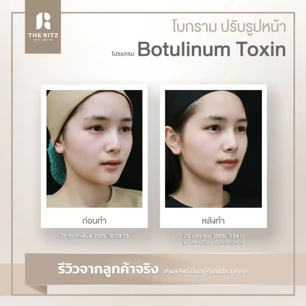 botulinum toxin