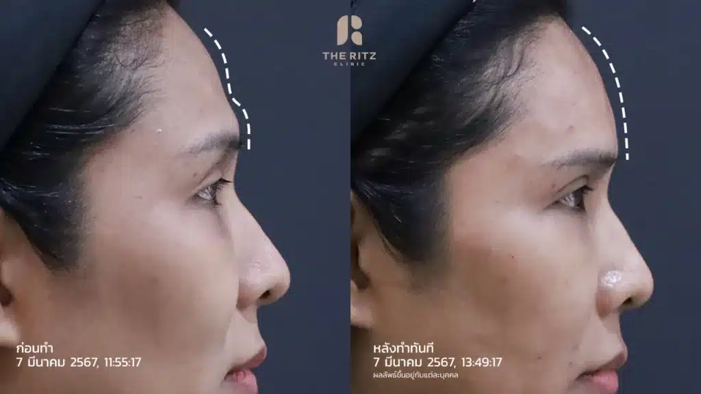 ภาพเปรียบเทียบหลังทำฟิลเลอร์หน้าผากทันที