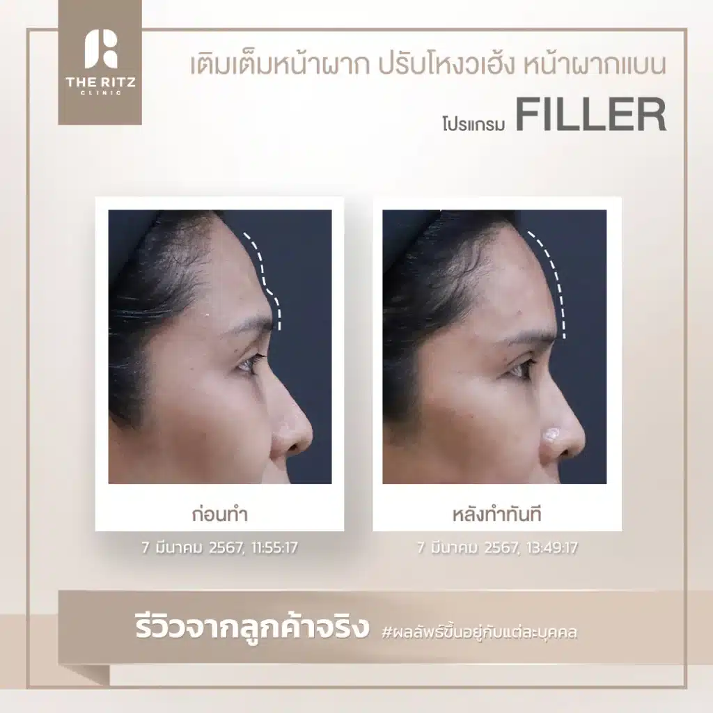 รีวิวฟิลเลอร์หน้าผาก ปรับโหงวเฮ้ง แก้หน้าผากแบน