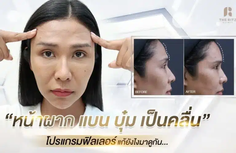 รีวิวฟิลเลอร์หน้าผาก แก้ปัญหาหน้าผากแบน ปรับใบหน้าให้สวยหวานละมุน