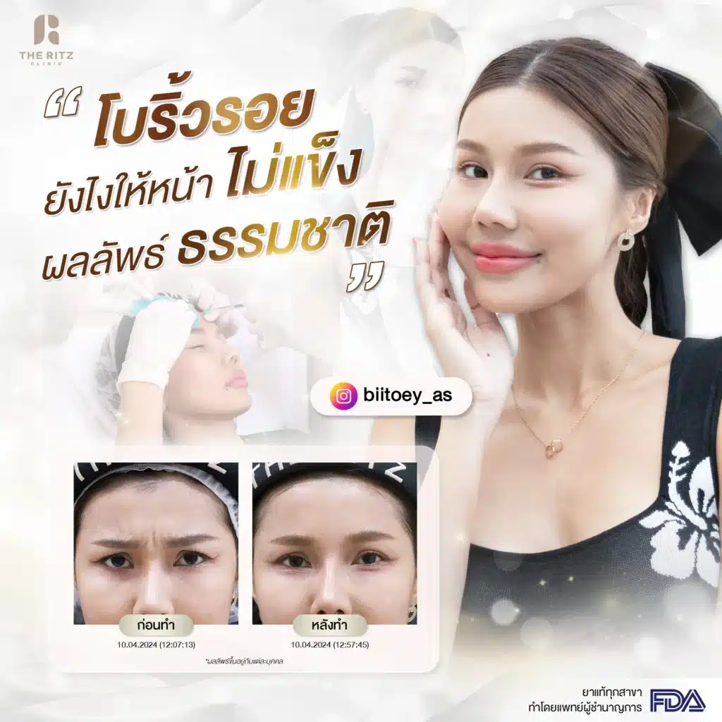 เคลียร์ชัด ฉีดโบท็อกกี่วันเห็นผล แต่ละตำแหน่งต่างกันอย่างไร