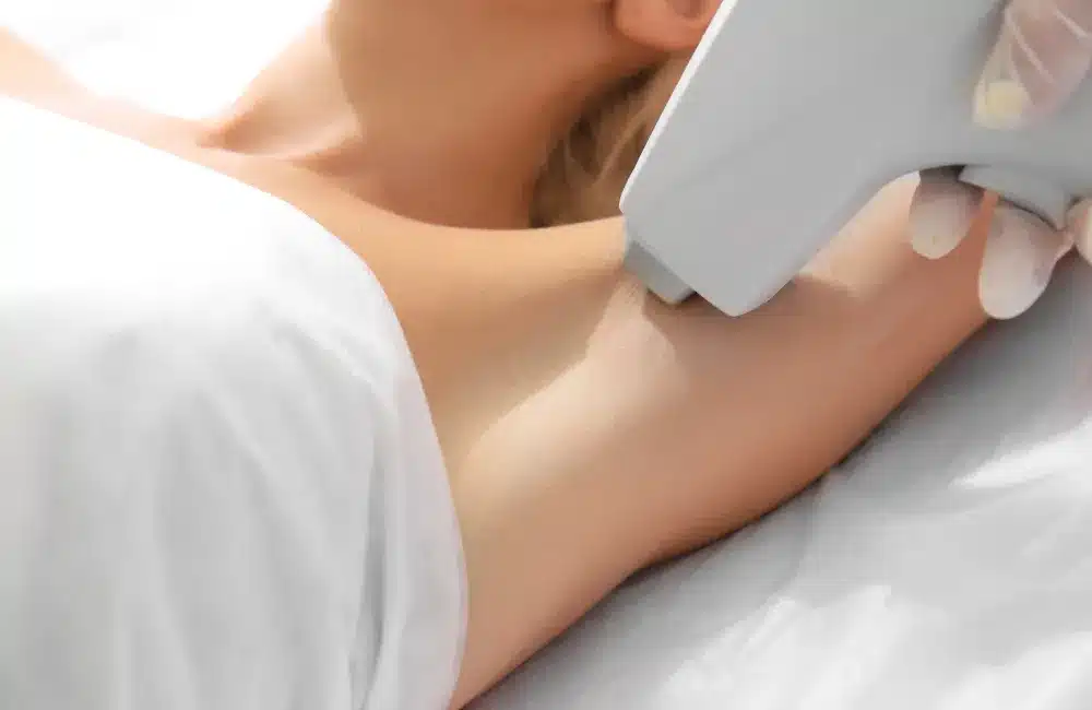 การยิงเลเซอร์กำจัดขน (Laser Hair Removal)