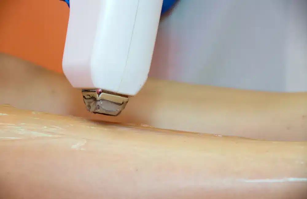 เลเซอร์ขน กำจัดขนถาวรได้จริงไหม