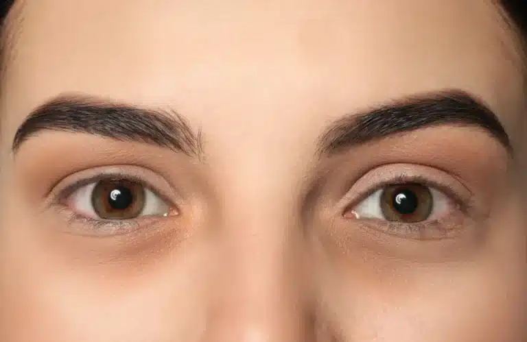 ฉีดโบท็อกถุงใต้ตาช่วยได้จริง มีข้อควรระวังอะไรบ้าง