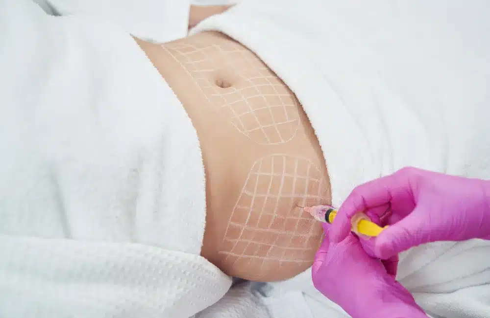 ฉีดเมโสแฟตหน้าท้อง ลดพุง