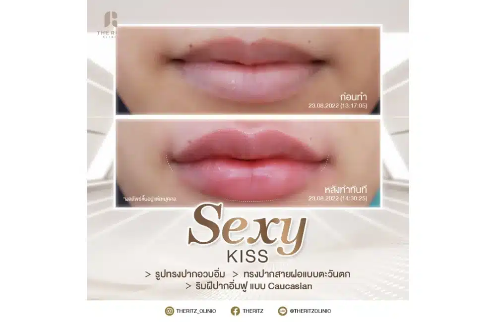 รีวิวฉีดปากสายฝอ