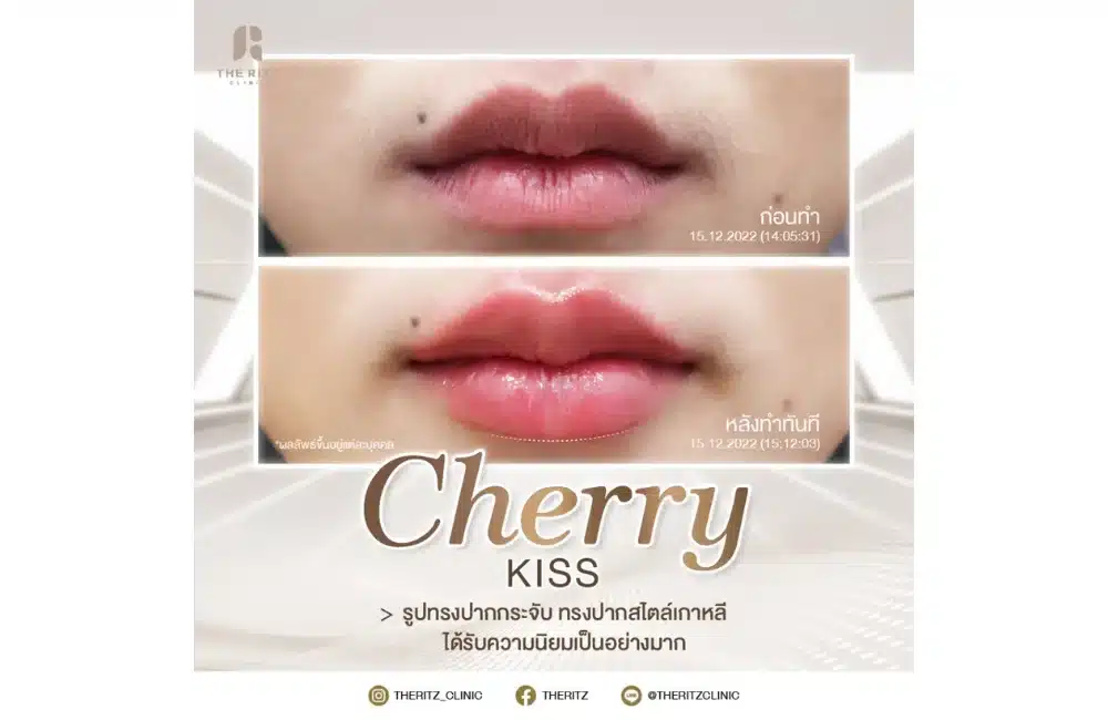 รีวิวฉีดปากสายฝอ