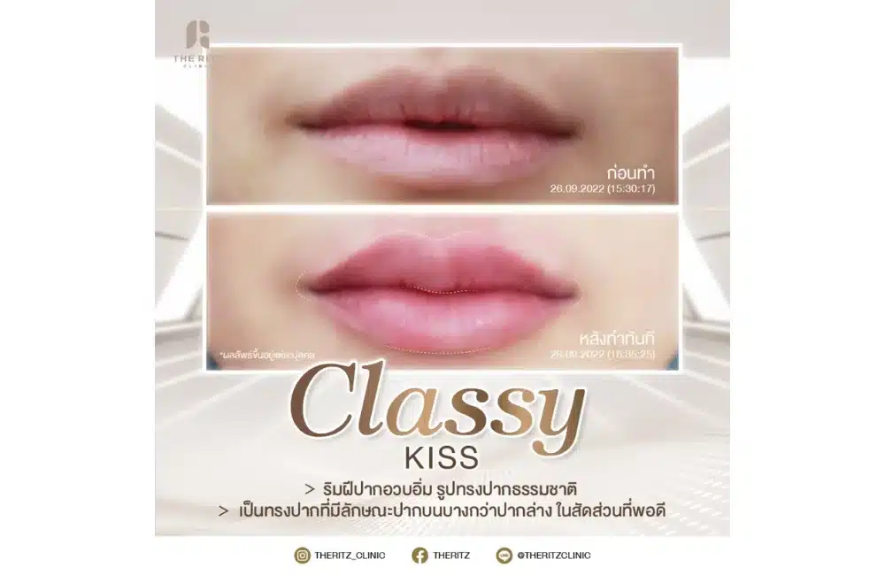 รีวิวฉีดปากสายฝอ