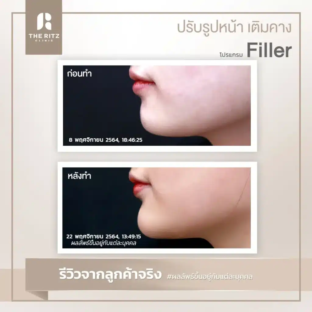 รีวิวฉีดฟิลเลอร์ THE RITZ CLINIC