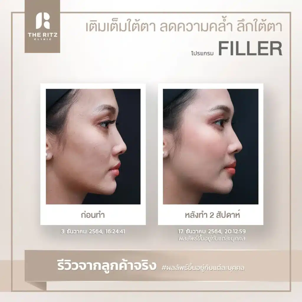 รีวิวฉีดฟิลเลอร์ THE RITZ CLINIC