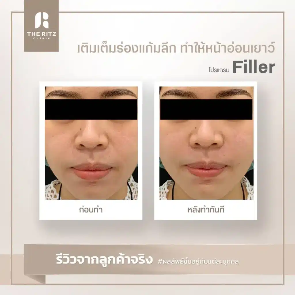 รีวิวฉีดฟิลเลอร์ THE RITZ CLINIC