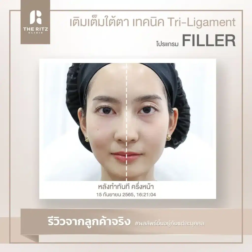 รีวิวฟิลเลอร์