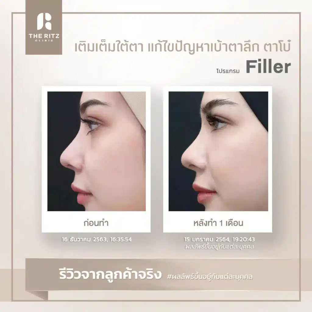 รีวิวฟิลเลอร์