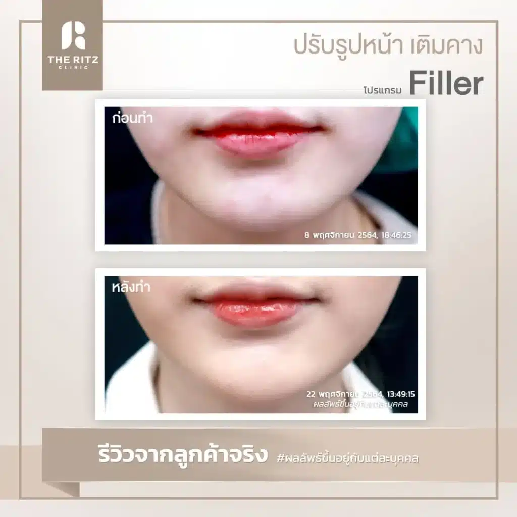 รีวิวฟิลเลอร์