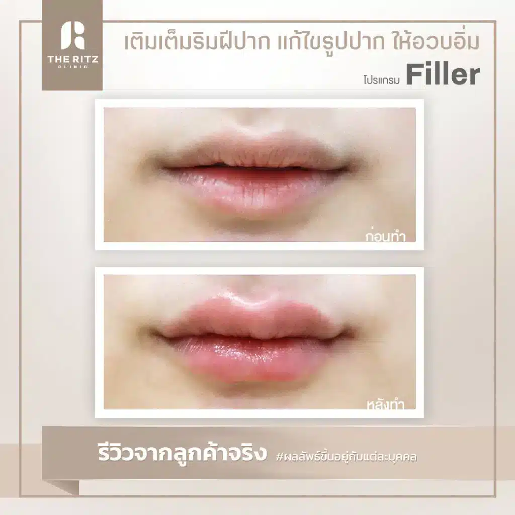 รีวิวปากกระจับธรรมชาติ