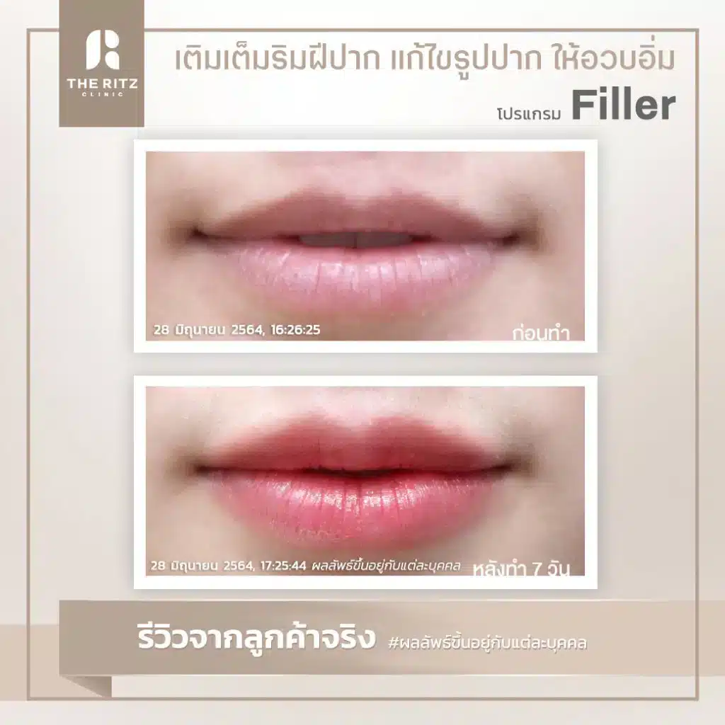 รีวิวทำปากกระจับ