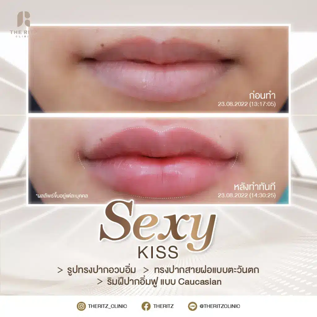 รีวิวทรงปาก Sexy Kysse