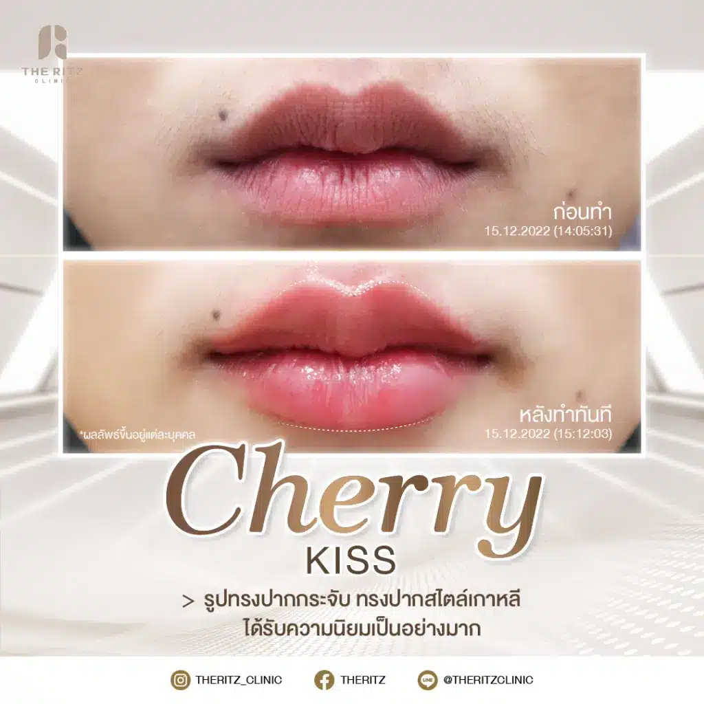 รีวิวทรงปาก Cherry Kysse