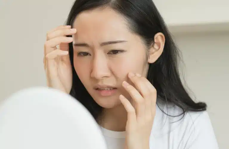 cover หลุมสิวเกิดจากอะไร_ รู้ทันสาเหตุ และวิธีรักษาที่เห็นผล