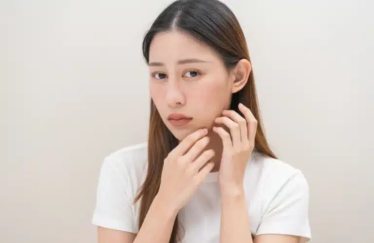 cover รอยดำจากสิว กี่วันหาย_ รวม 10 วิธีรักษาให้ผิวใส จบปัญหารอยกวนใจ