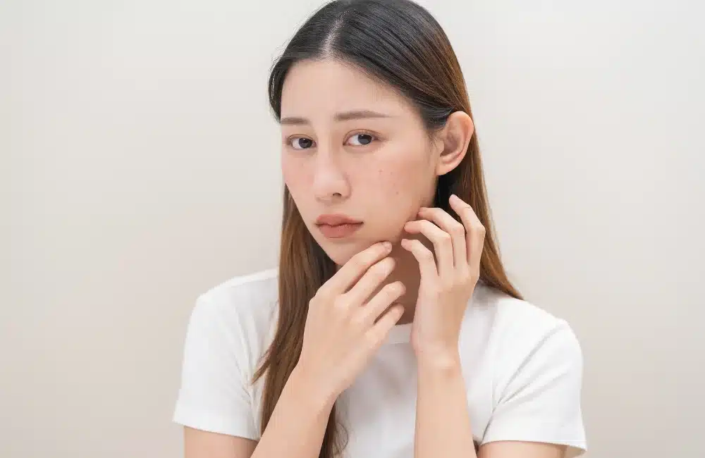 10 วิธีรักษารอยสิว ทั้งรอยดำและรอยแดงให้ผิวใส จบปัญหารอยกวนใจ