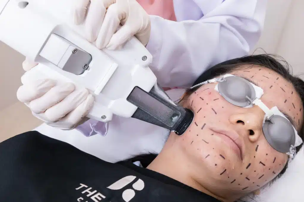 รักษาสิวแพ้แมสก์