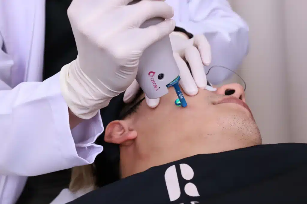 เครื่องเลเซอร์รอยสิว