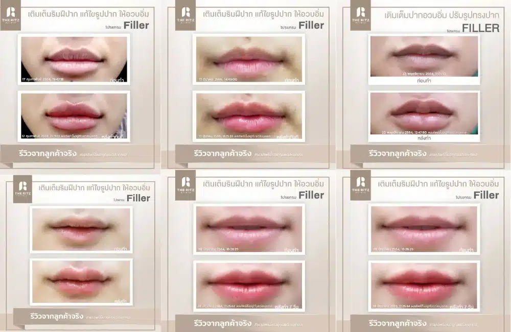 รีวิวฉีดฟิลเลอร์