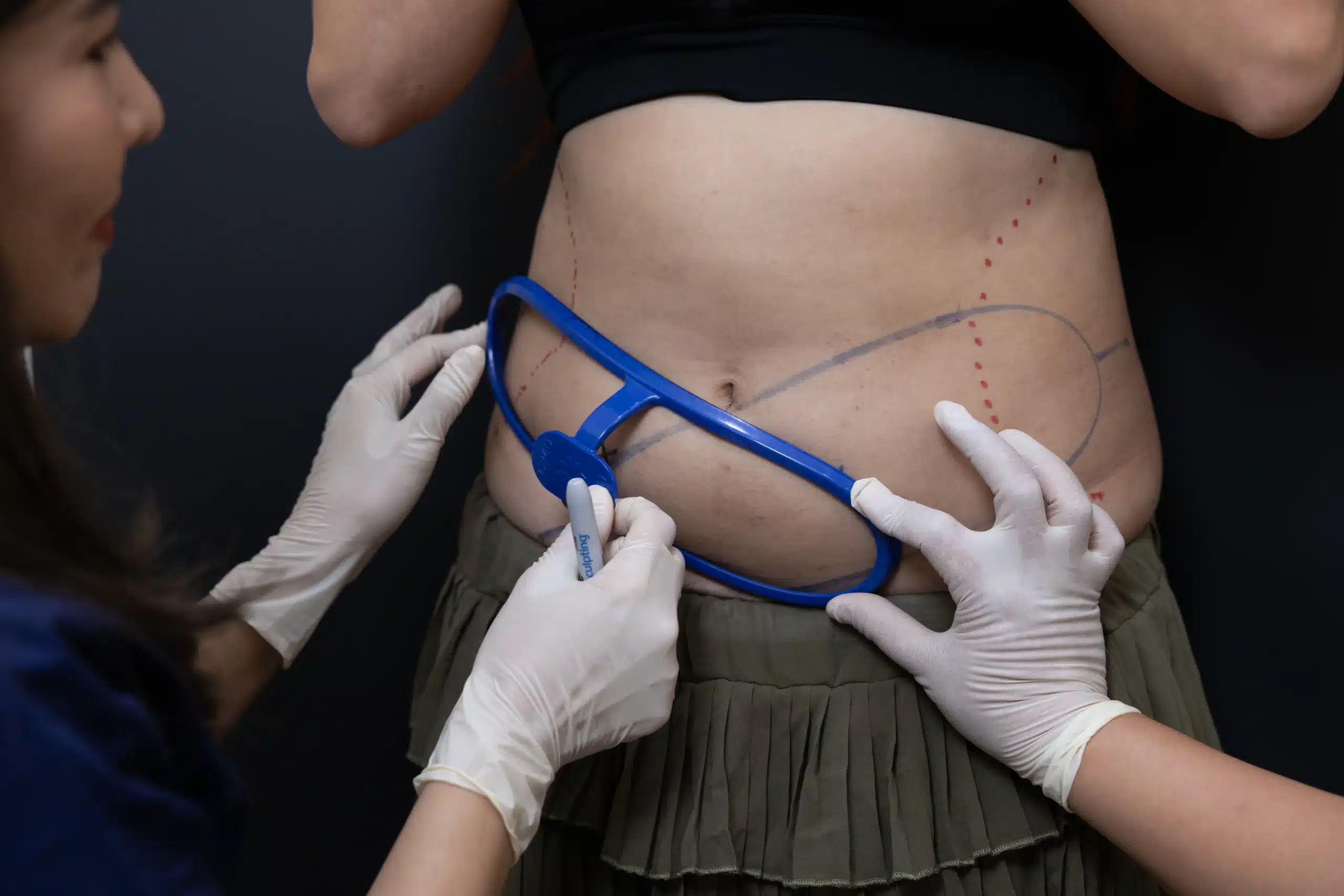 การทำ CoolSculpting เหมาะกับใคร