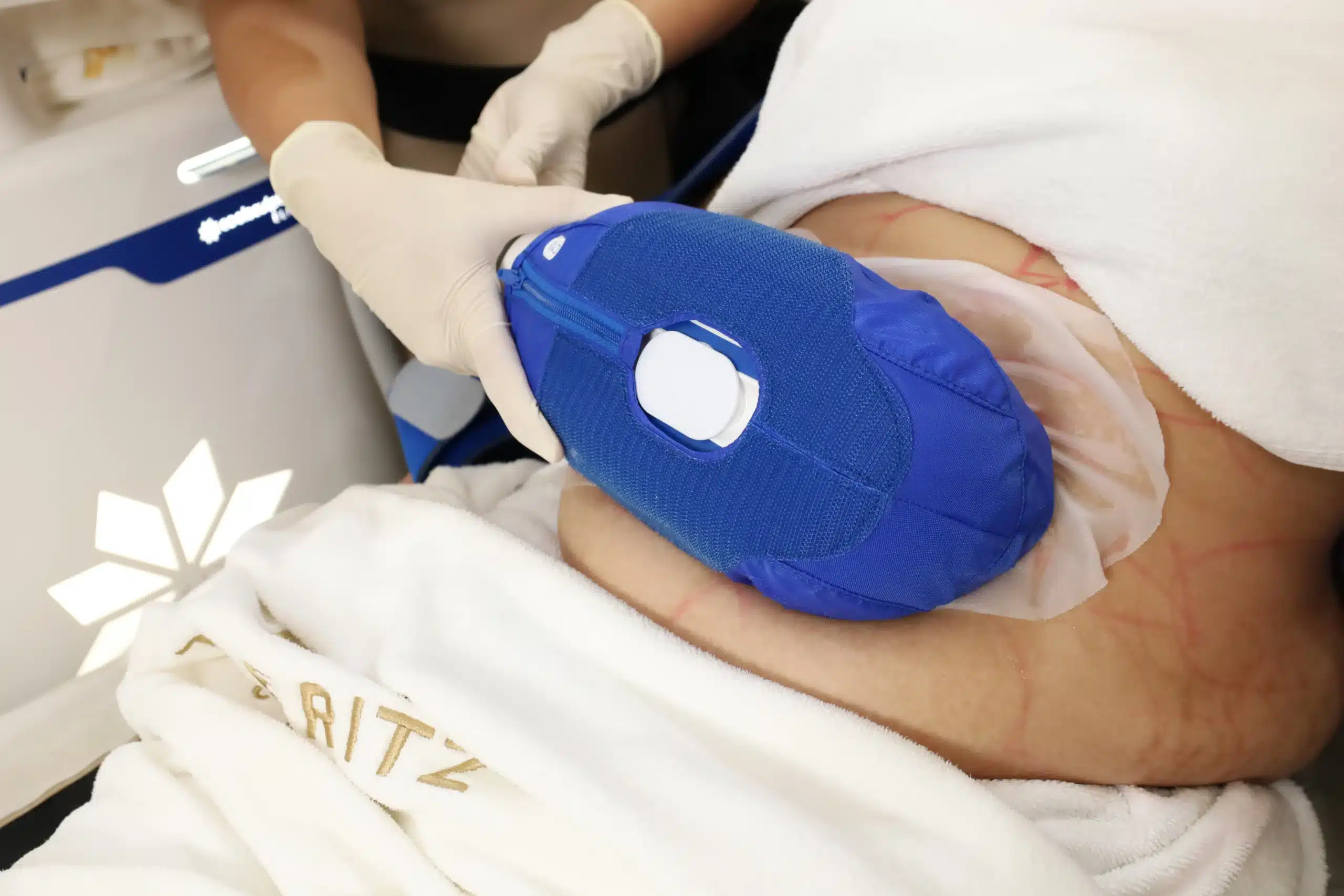 ขั้นตอนการทำ CoolSculpting