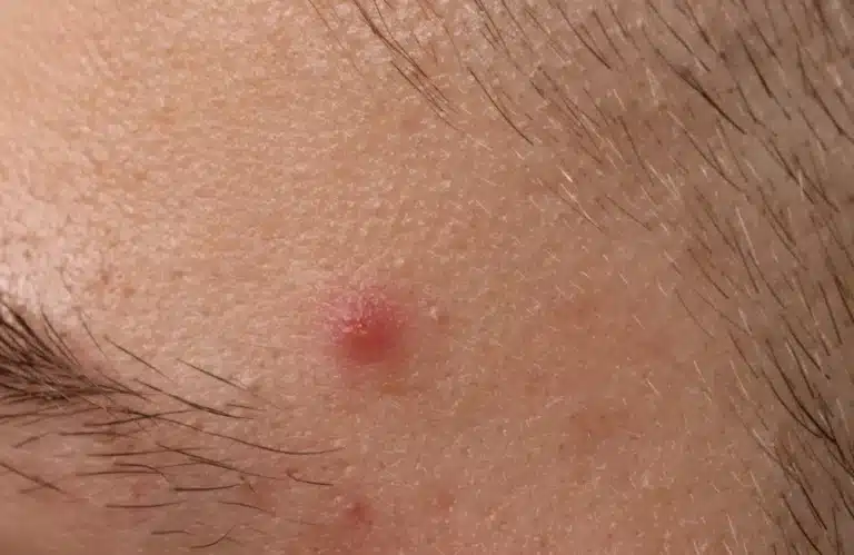 สิวอุดตัน คืออะไร?