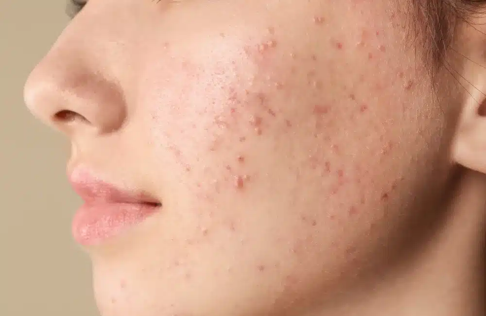 สิวอุดตัน คืออะไร? รู้จักศัตรูตัวร้ายของผิวเรียบเนียน