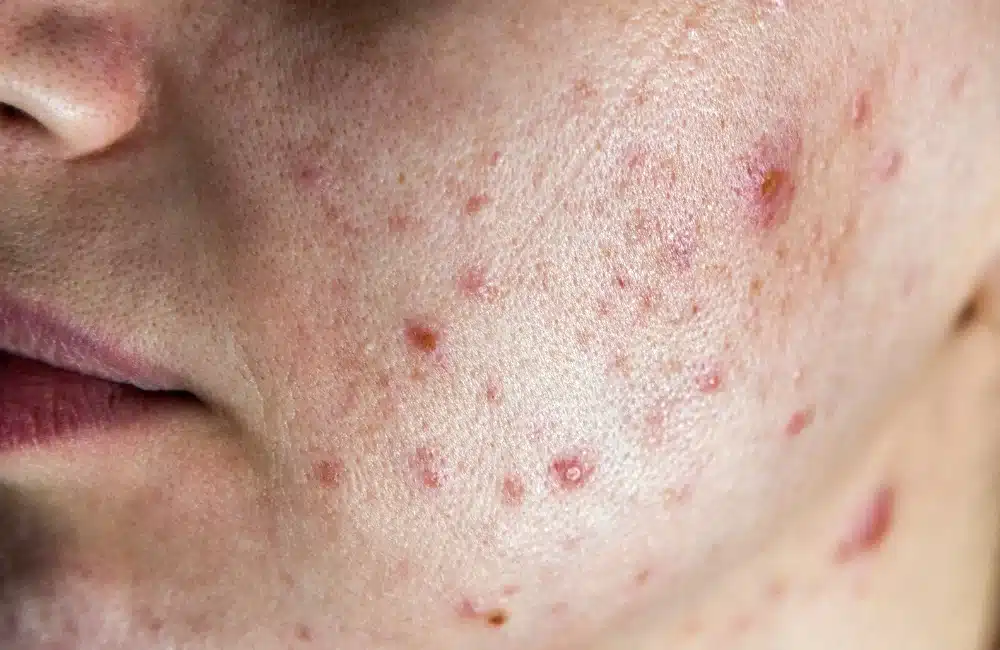 สิวสเตียรอยด์ คืออะไร? ทำไมถึงต่างจากสิวทั่วไป