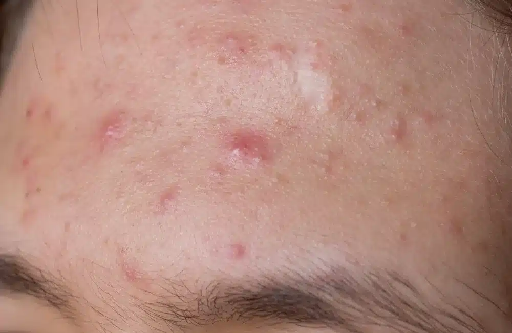 สาเหตุหลักของการเกิดสิวสเตียรอยด์