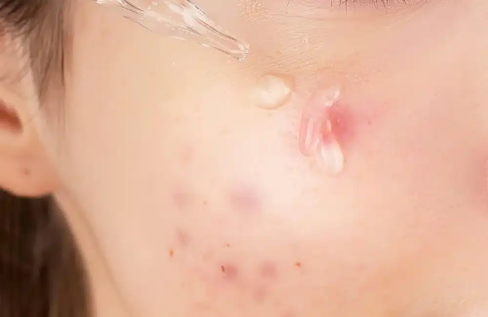 4. ใช้ยาทากลุ่มเรตินอยด์ (Retinoids)