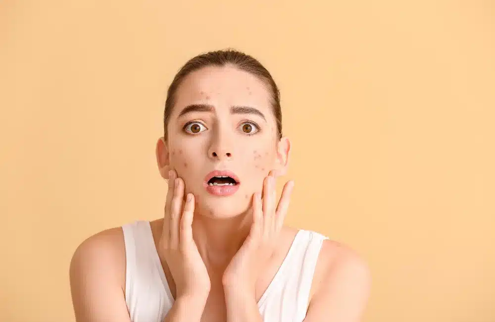 สิวอุดตัน