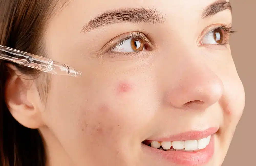 สิวอุดตัน